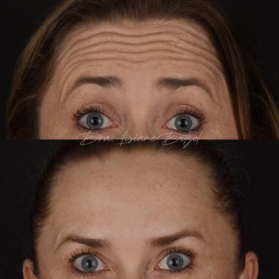 Botox